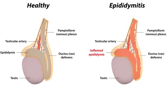 epididymis swollen